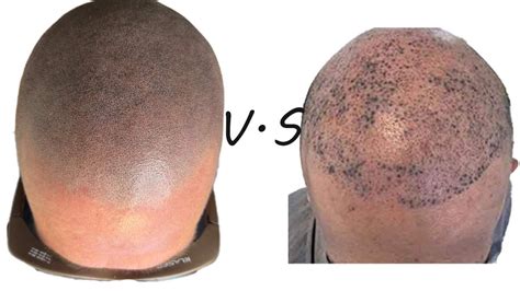 scalp micropigmentation regrets|The 5 Biggest Regrets of Scalp Micropigmentation and How to .